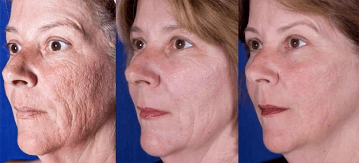 Rezultatul după procedura de întinerire a pielii faciale cu laser