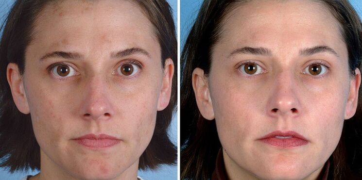 înainte și după întinerirea pielii cu dispozitivul