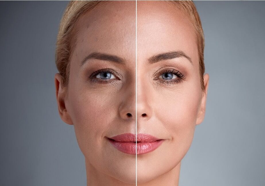 înainte și după întinerirea facială cu laser