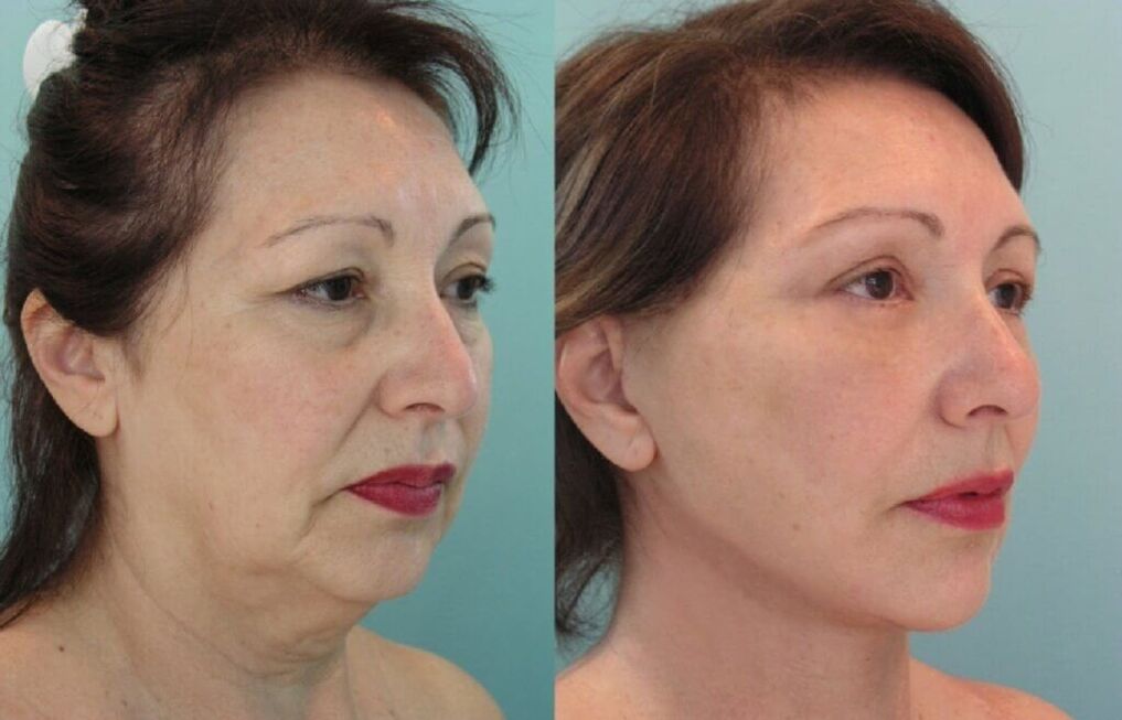 fotografie înainte și după întinerirea pielii
