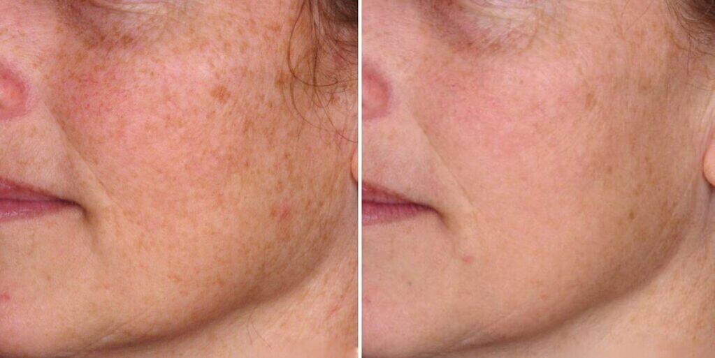 pielea feței înainte și după întinerire